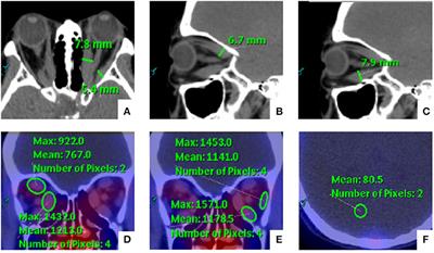 Monitoring and Predicting Treatment Response of Extraocular Muscles in Grave's Orbitopathy by 99mTc-DTPA SPECT/CT